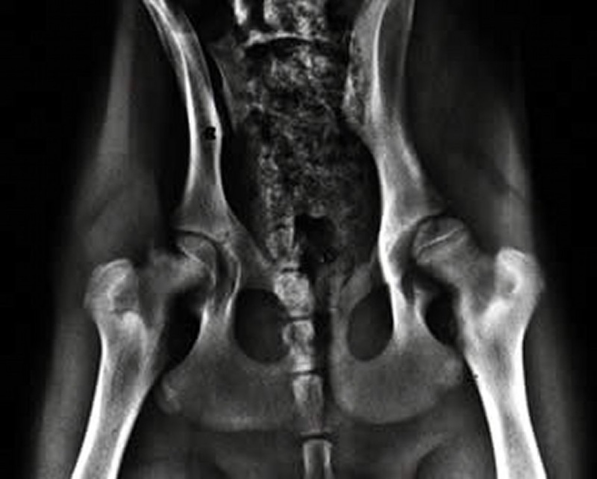 Capital physeal fracture