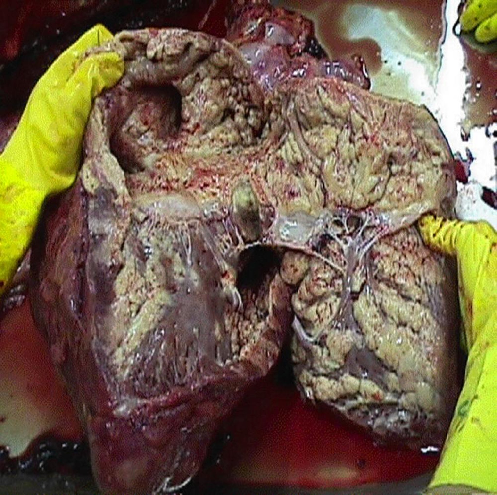 Cardiac lymphosarcoma, cow
