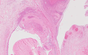 Caseous tenosynovitis, poultry