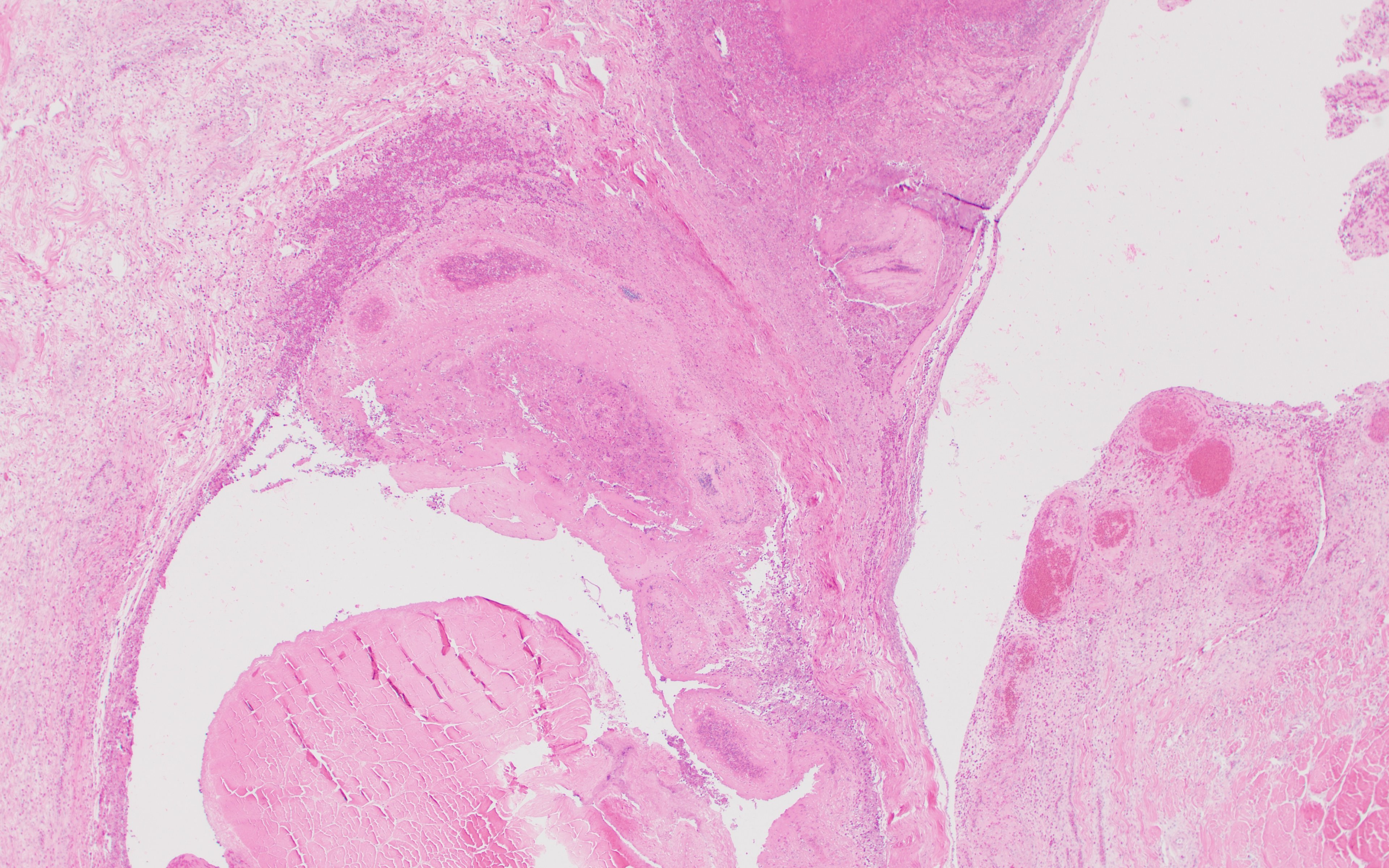 Caseous tenosynovitis, photomicrograph, poultry