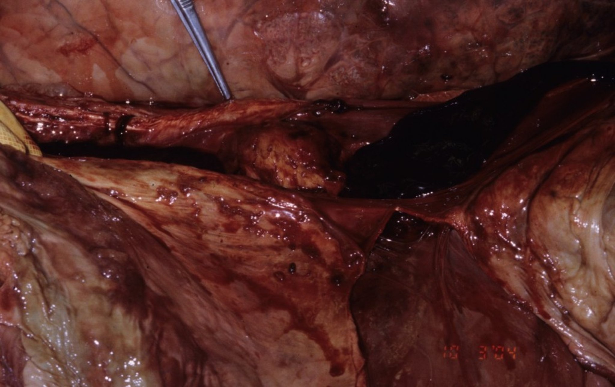 Caudal vena cava thrombosis