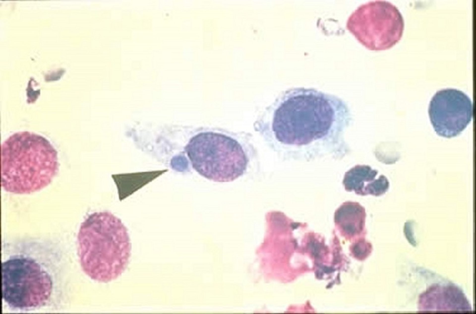 Chlamydial keratoconjunctivitis, cytology, cat