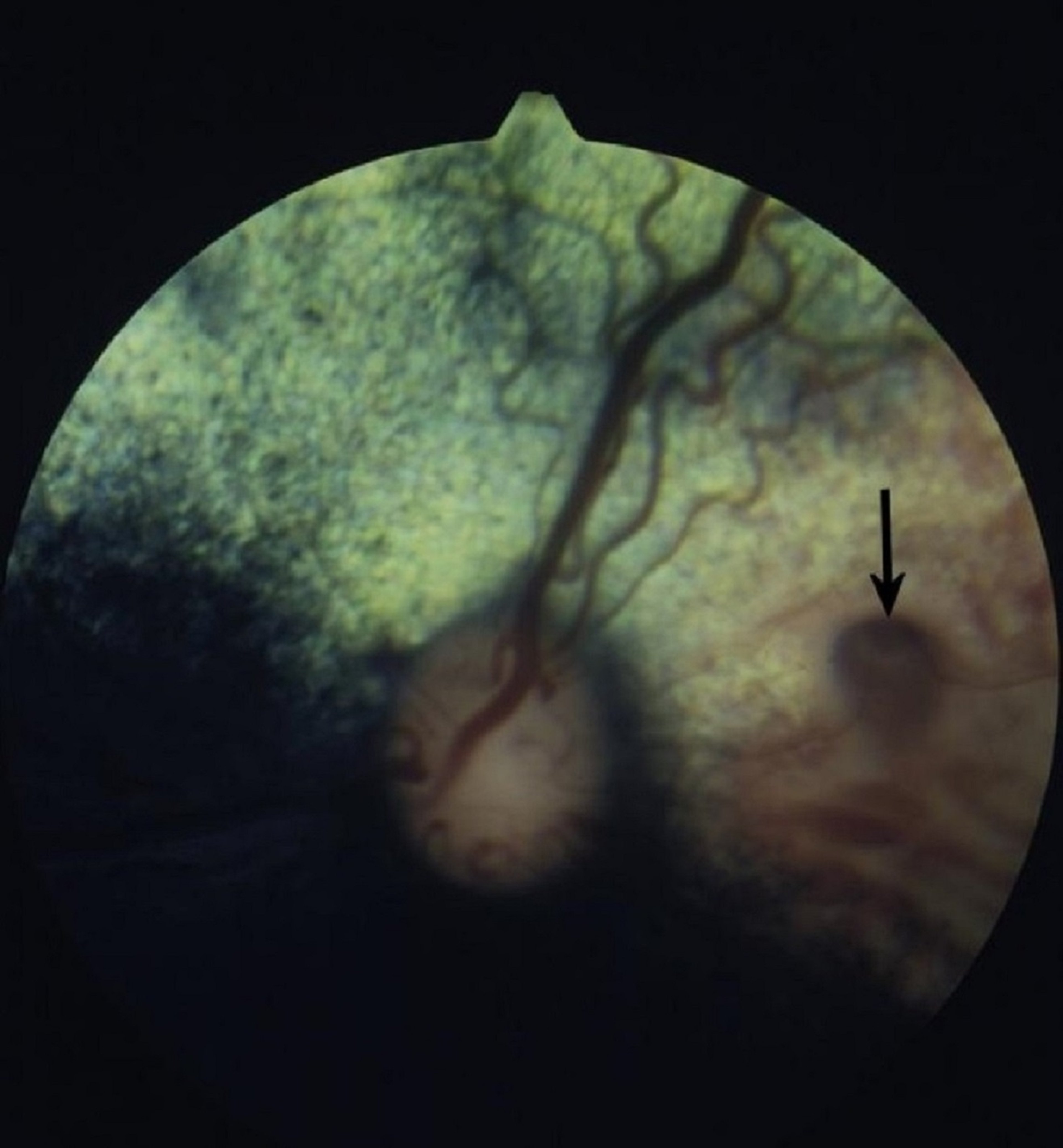 Choroidal hypoplasia and peripapillary coloboma, Collie