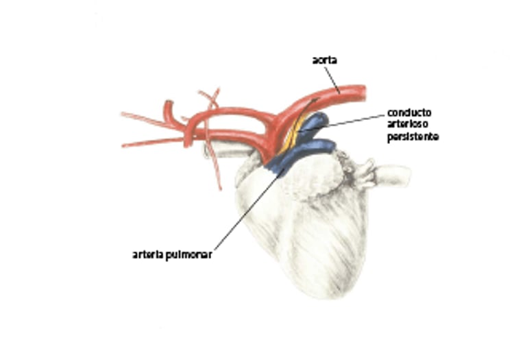 Conducto arterioso persistente