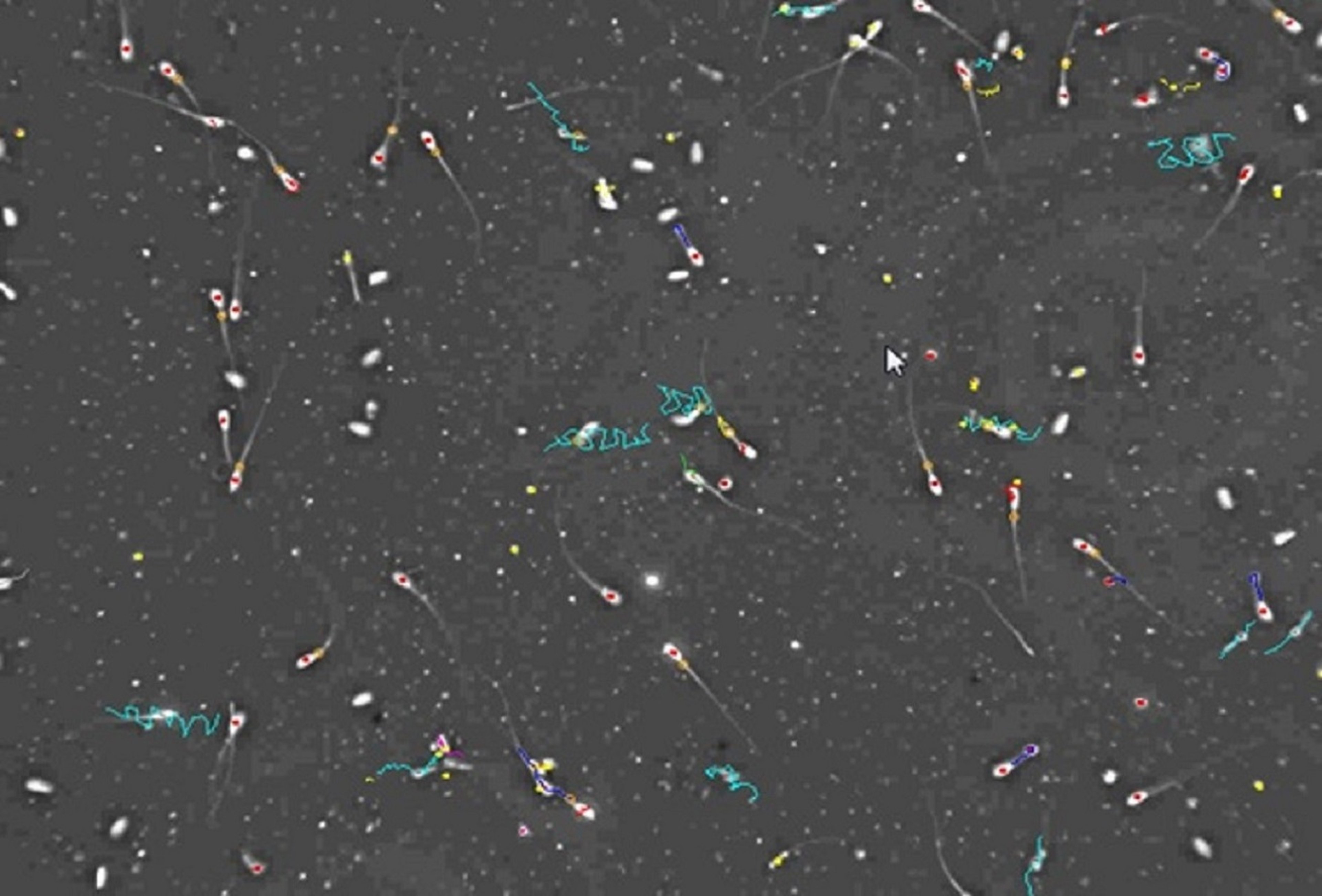 Computer-assisted semen analysis, poor sample