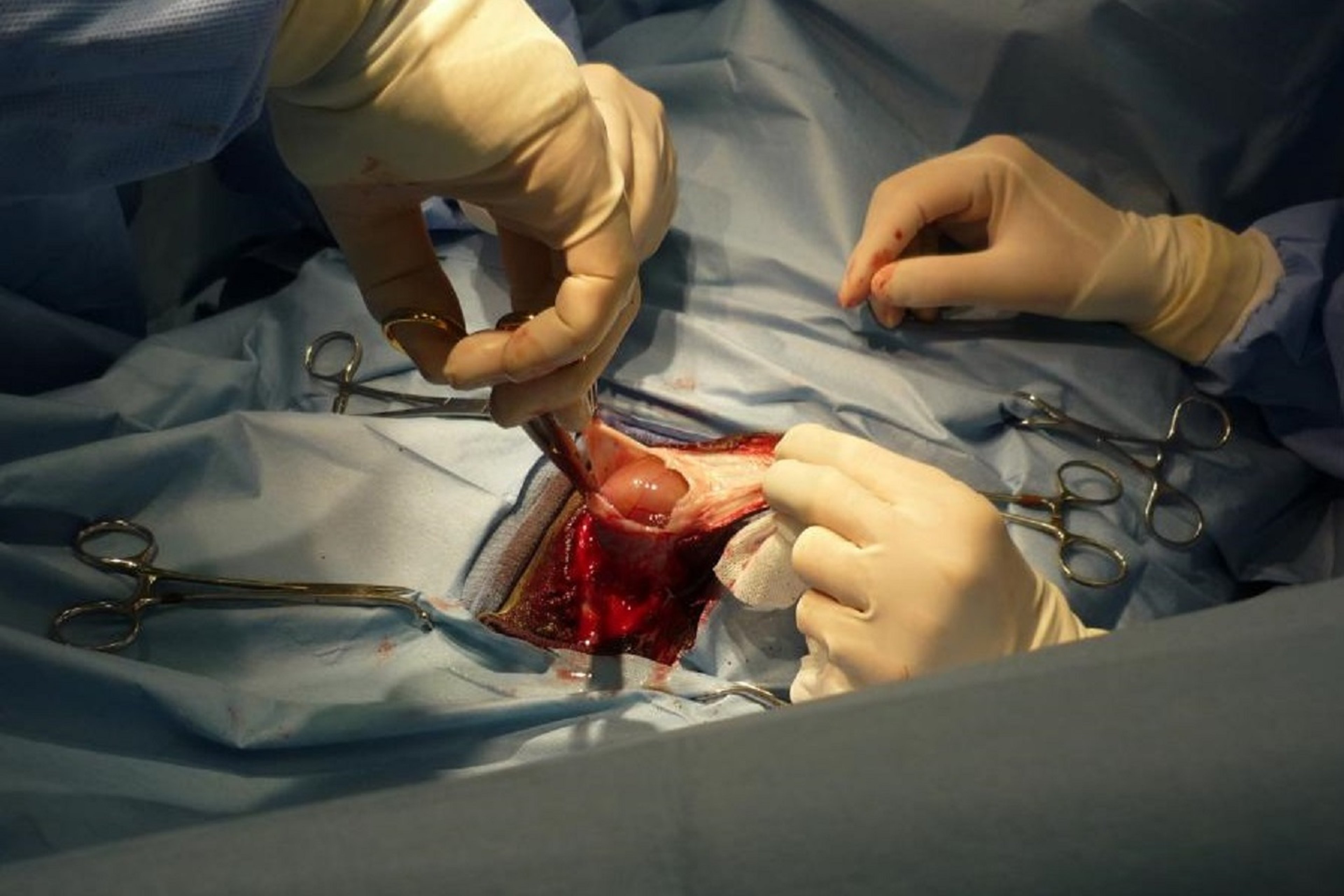 Congenital umbilical hernia, foal, opening hernia sac