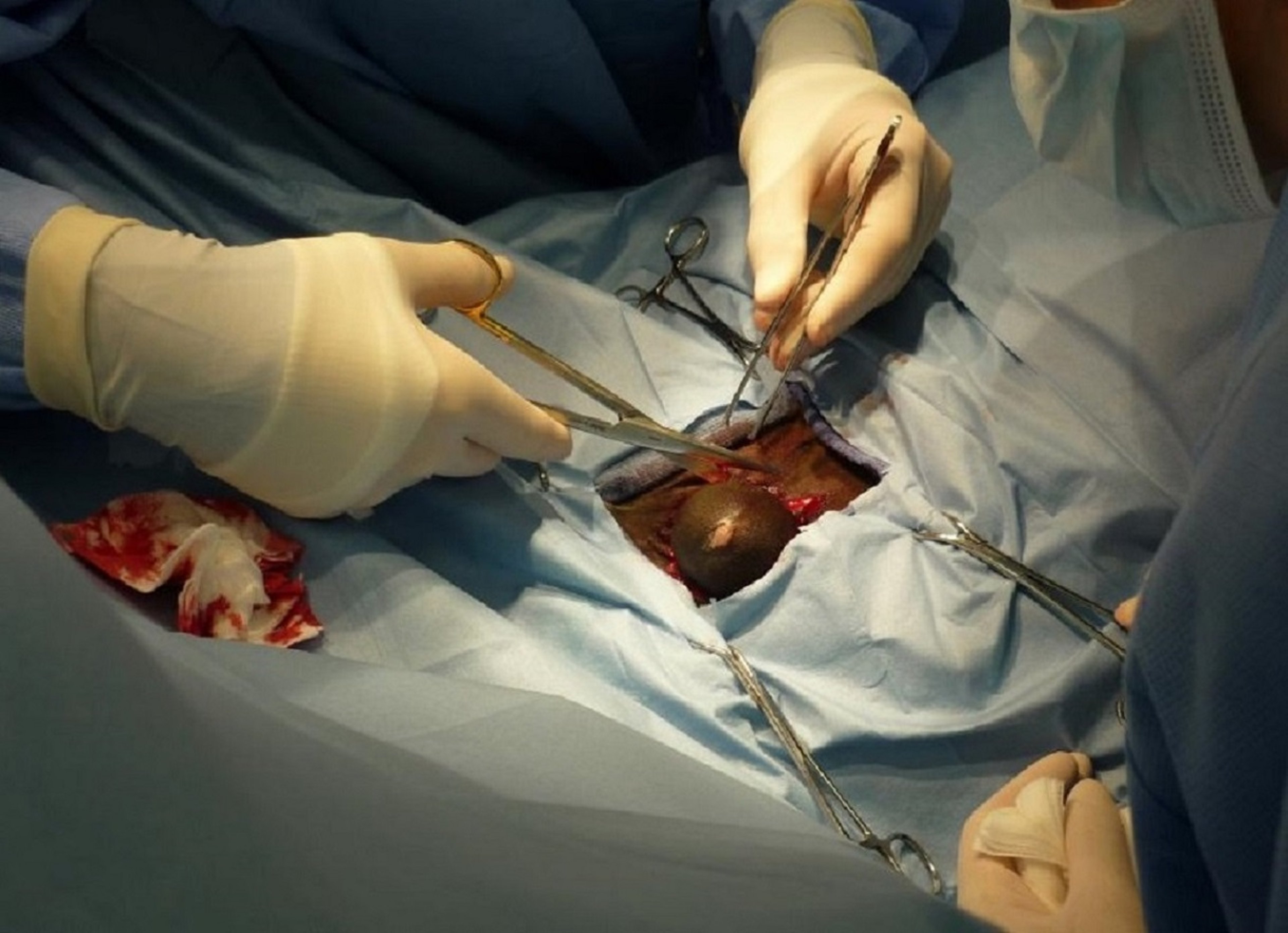 Congenital umbilical hernia, foal, surgical approach