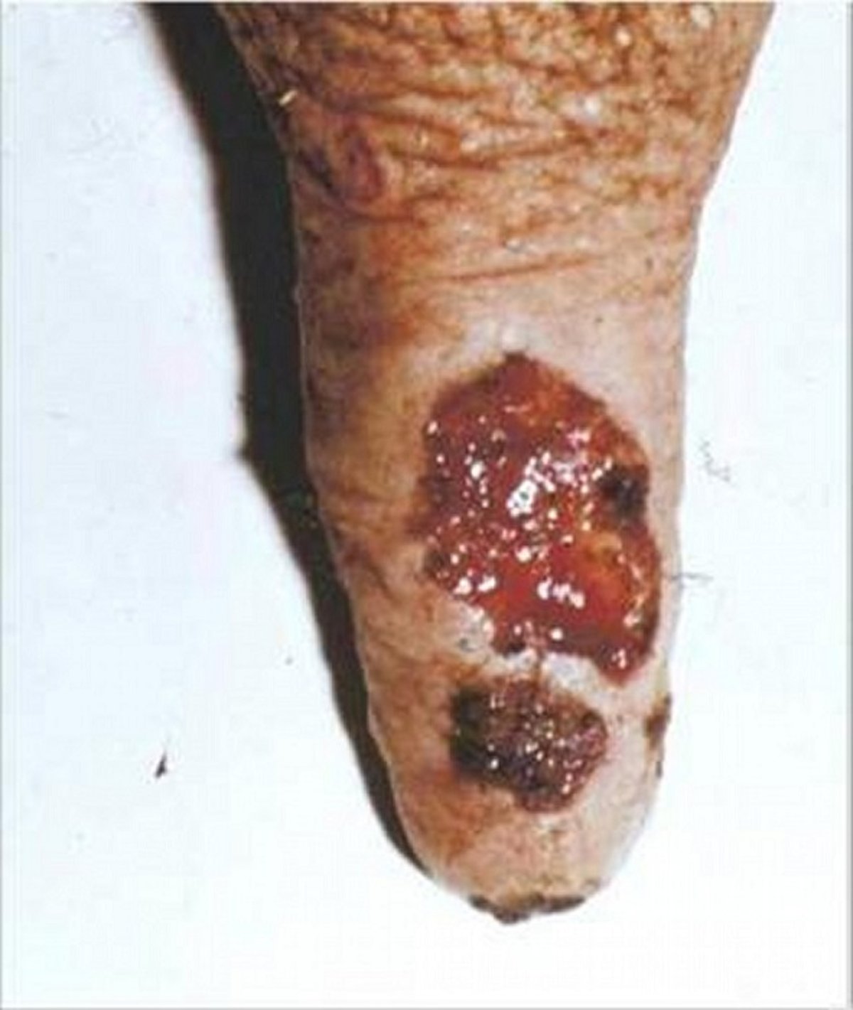 Cowpox ulcer on teat, cow
