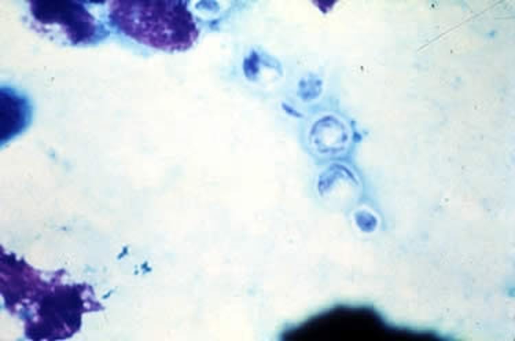 <i >Cryptococcus neoformans</i>, tissue smear