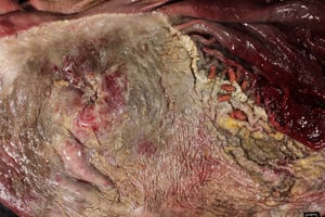 Gastritis hemorrágica, intoxicación por cantaridina