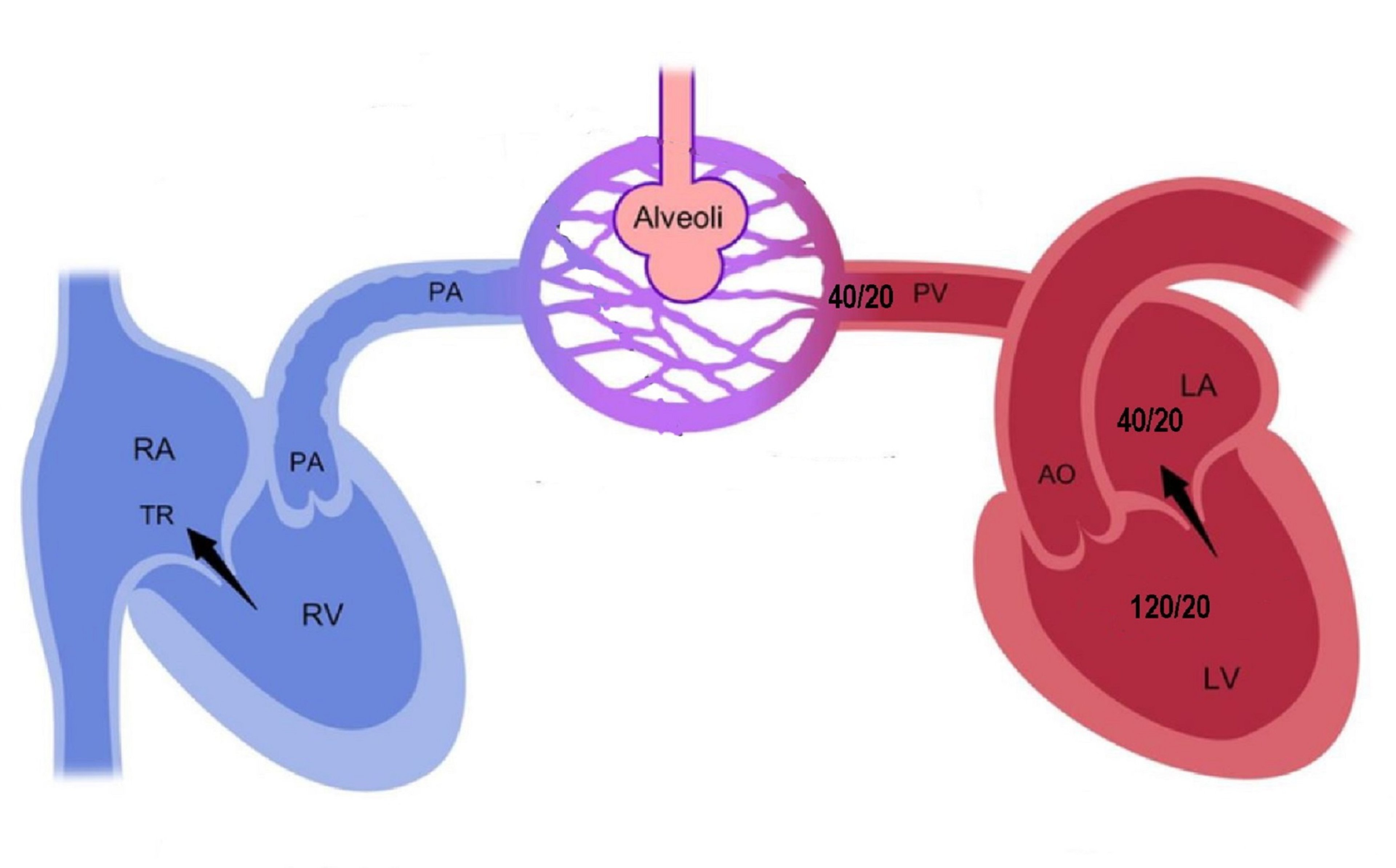 Edema pulmonar cardiogénico por regurgitación mitral