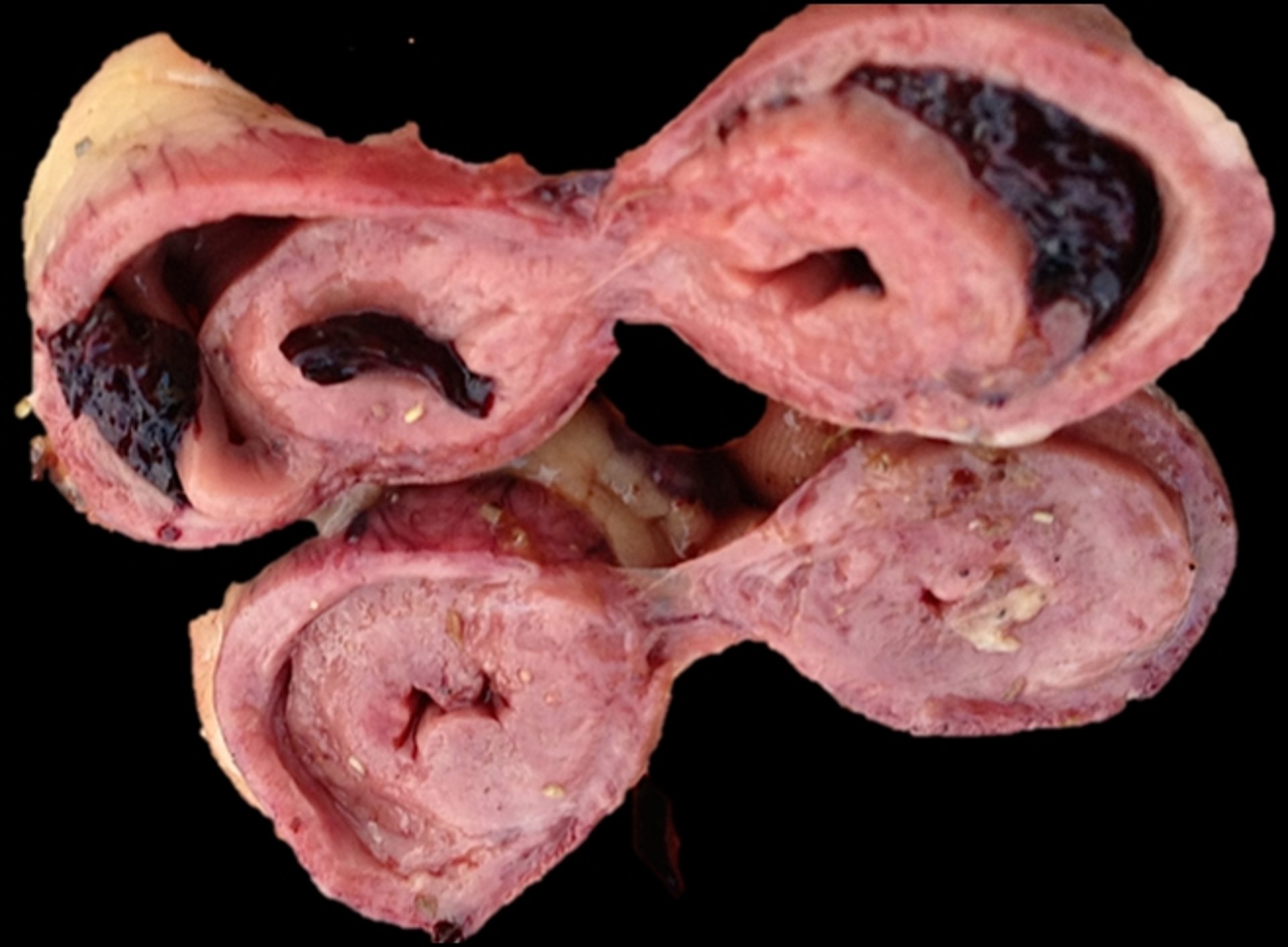 Cardiomyopathy, chicken
