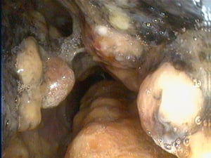 Crecimiento de la coliflor, cavidad nasal