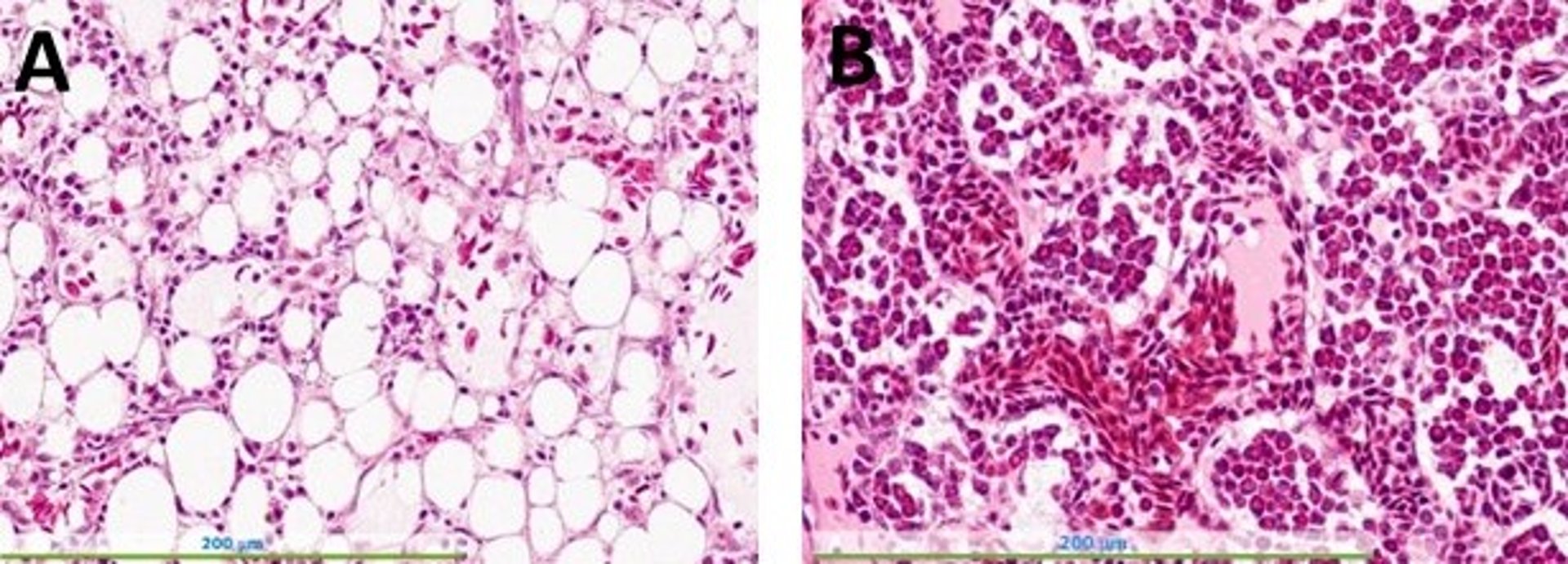 Chicken anemia virus infection, bone marrow