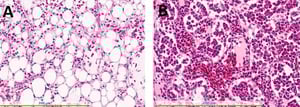 Infección por el virus de la anemia del pollo, médula ósea