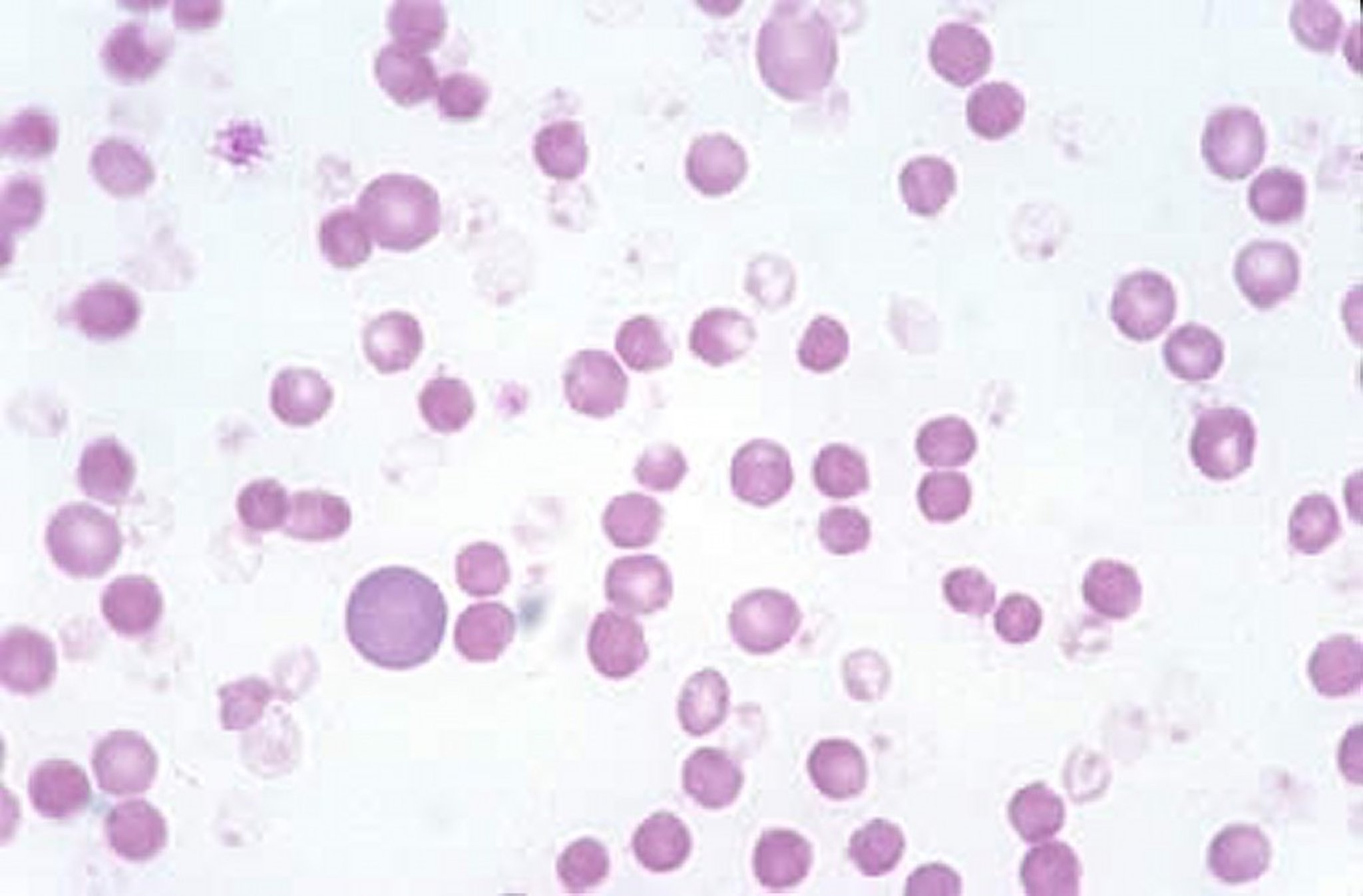 Frotis de sangre felina, cuerpos de Heinz en eritrocitos lisados, Wright-Giemsa