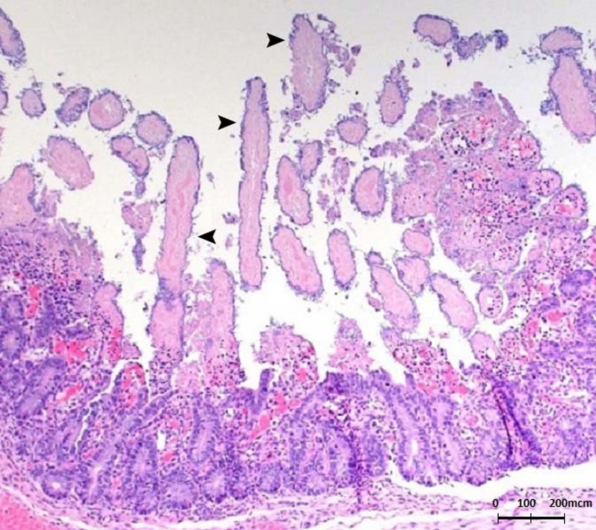Enteritis por <i >Clostridium perfringens</i> tipo C, histopatología