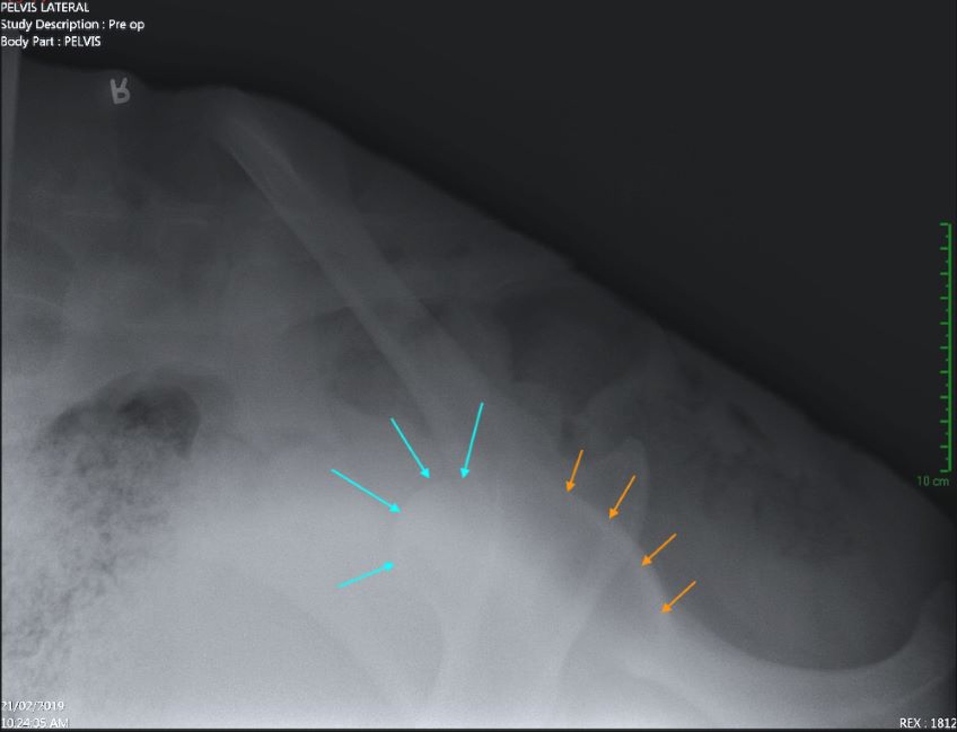 Luxação da articulação coxofemoral, radiografia pré-operatória em pé, pônei
