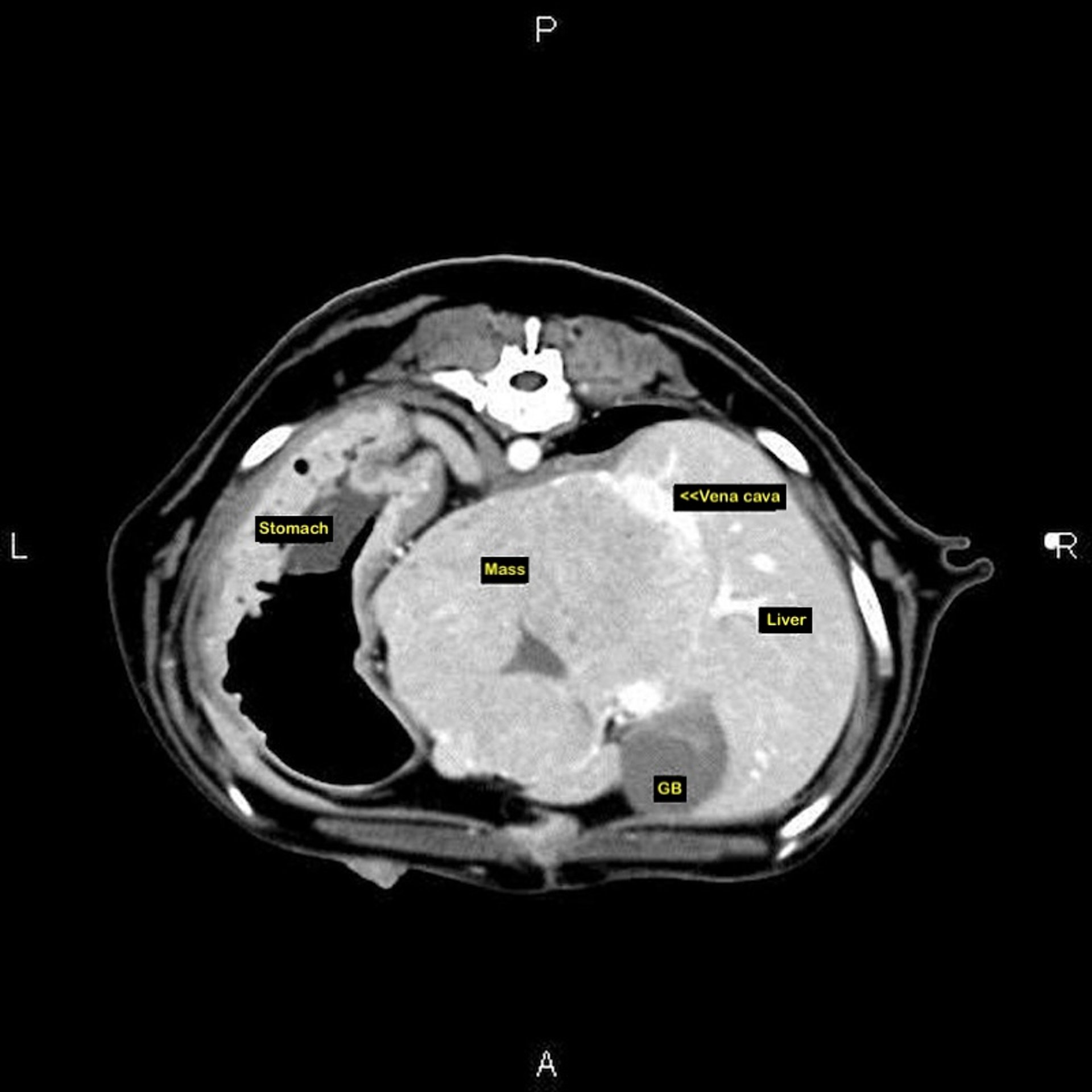CT, large hepatic mass