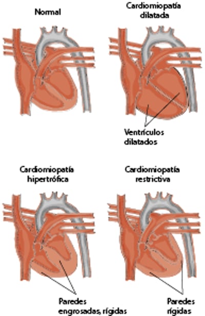 Tipos de cardiomiopatía hipertrófica en los gatos