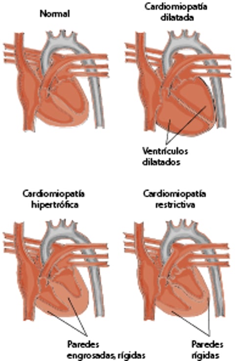 Tipos de cardiomiopatía hipertrófica en los gatos