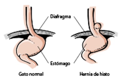 Hernia de hiato