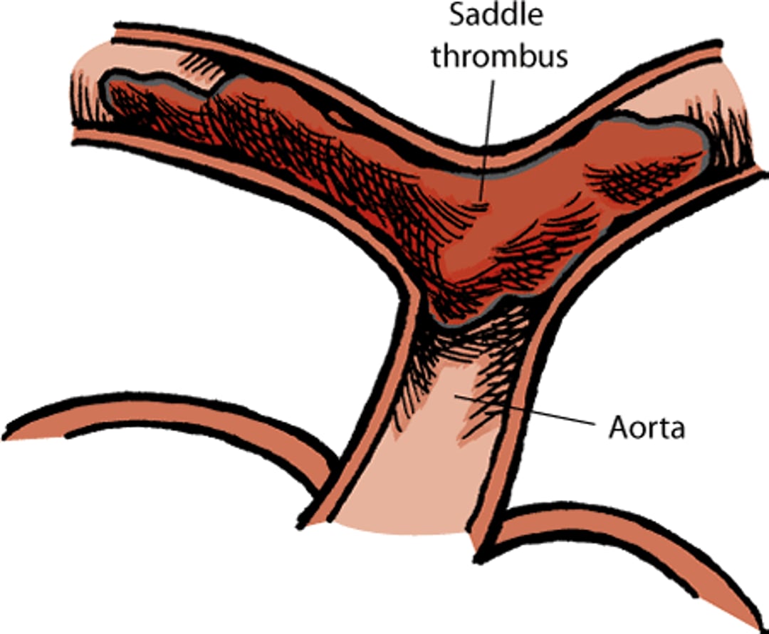 Thrombus