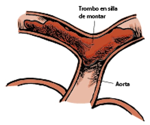 Trombo