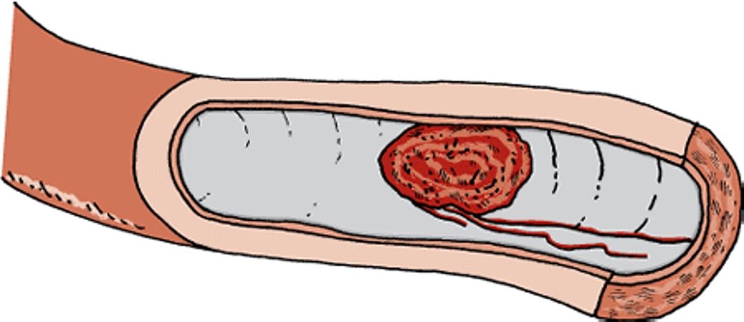 Blood clot