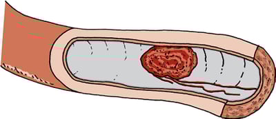 Blood clot