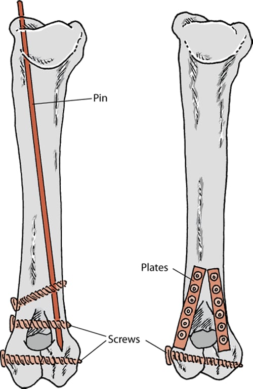 Bone fracture treatments