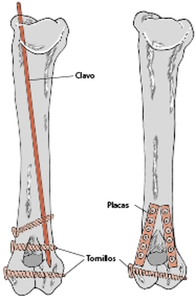 Tratamientos de fracturas óseas