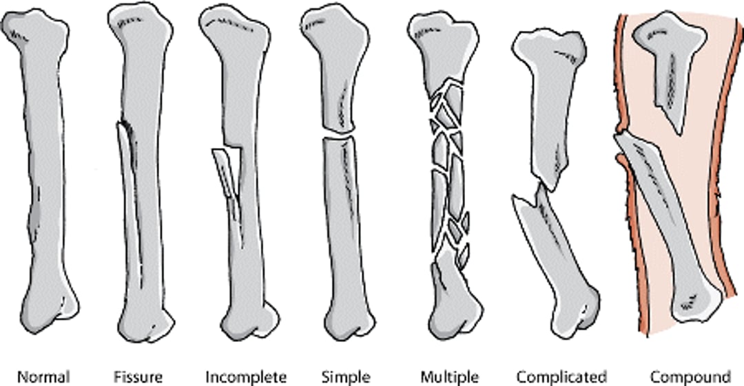 Bone fracture types
