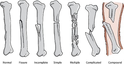 Bone fracture types