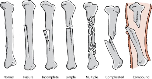 Bone fracture types