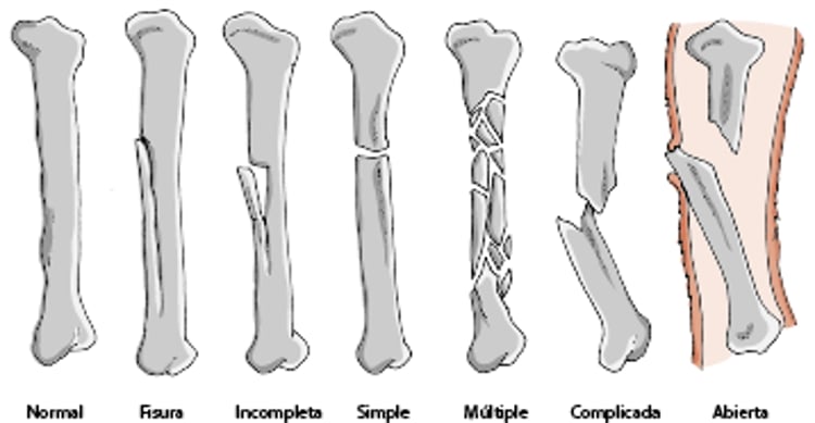 Tipos de fracturas óseas