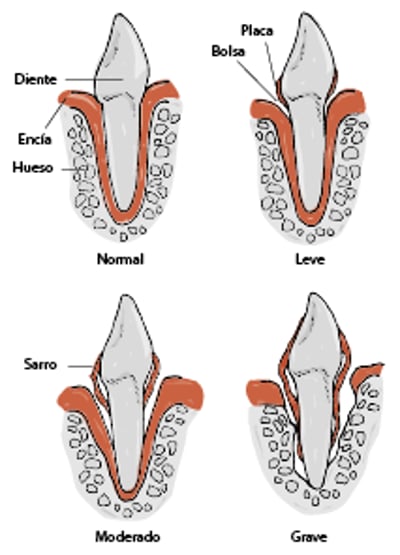 Progresión de la enfermedad periodontal en perros