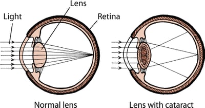 Lens with cataract, dog