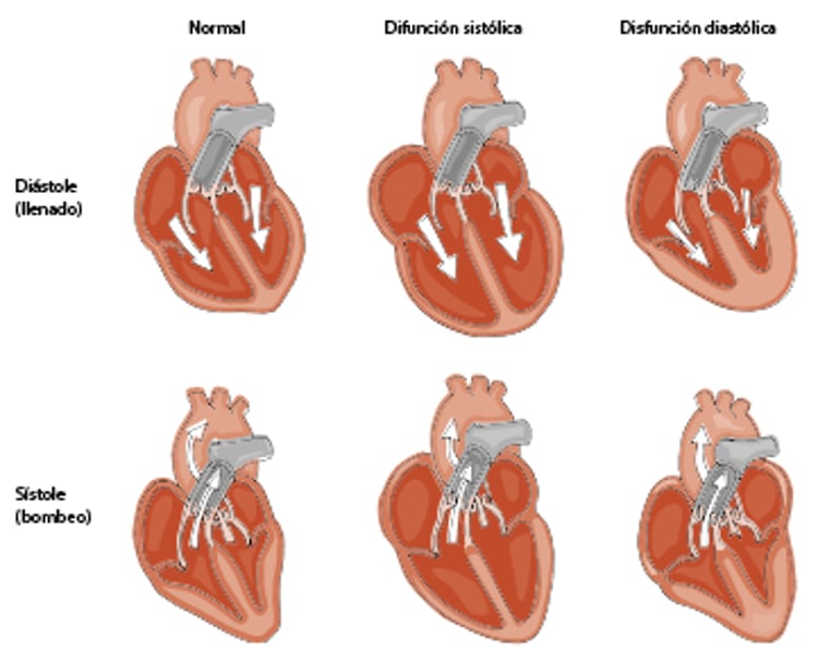 Insuficiencia cardiaca