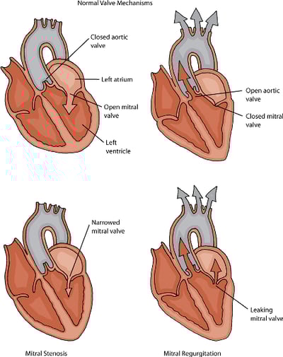 Mitral stenosis and regurgitation