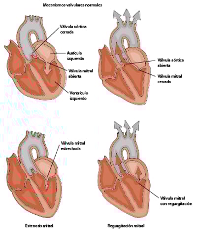Estenosis mitral y regurgitación