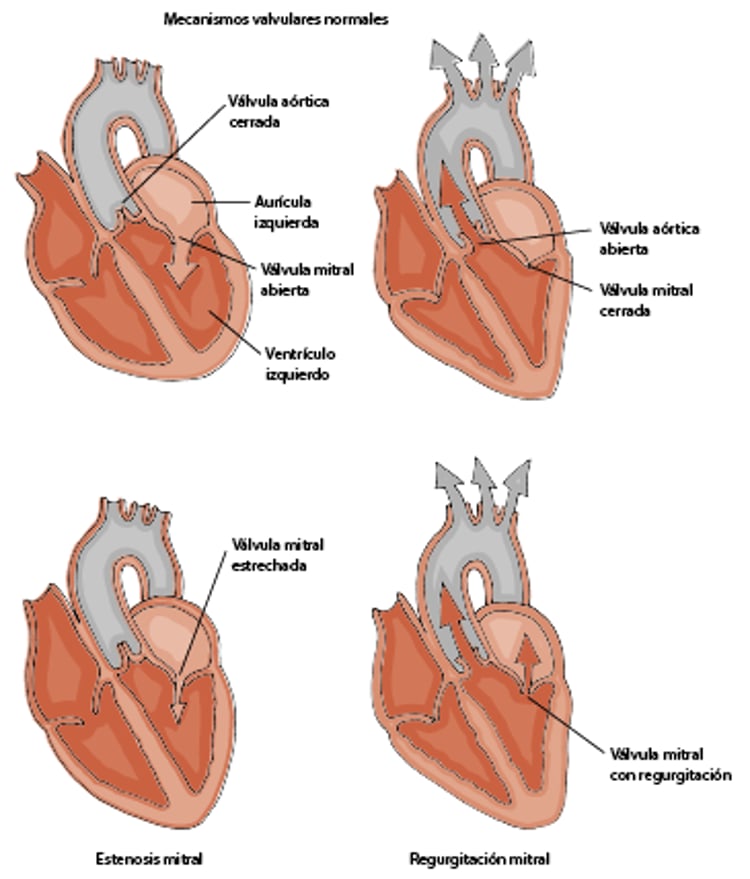 Estenosis mitral y regurgitación