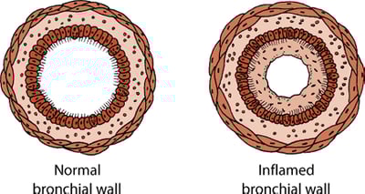 Tracheobronchitis