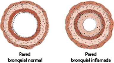 Traqueobronquitis