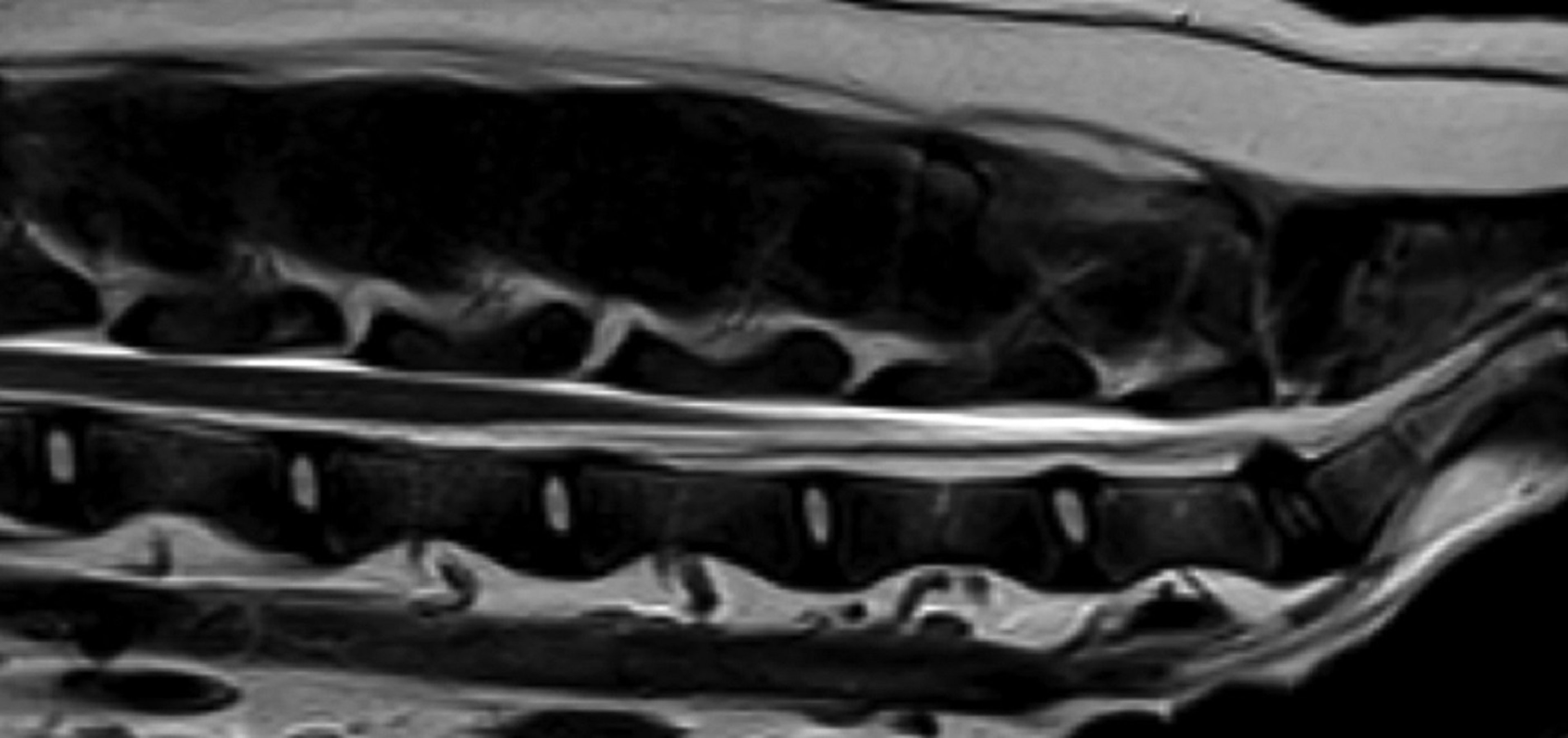 Degenerative lumbosacral stenosis, dog
