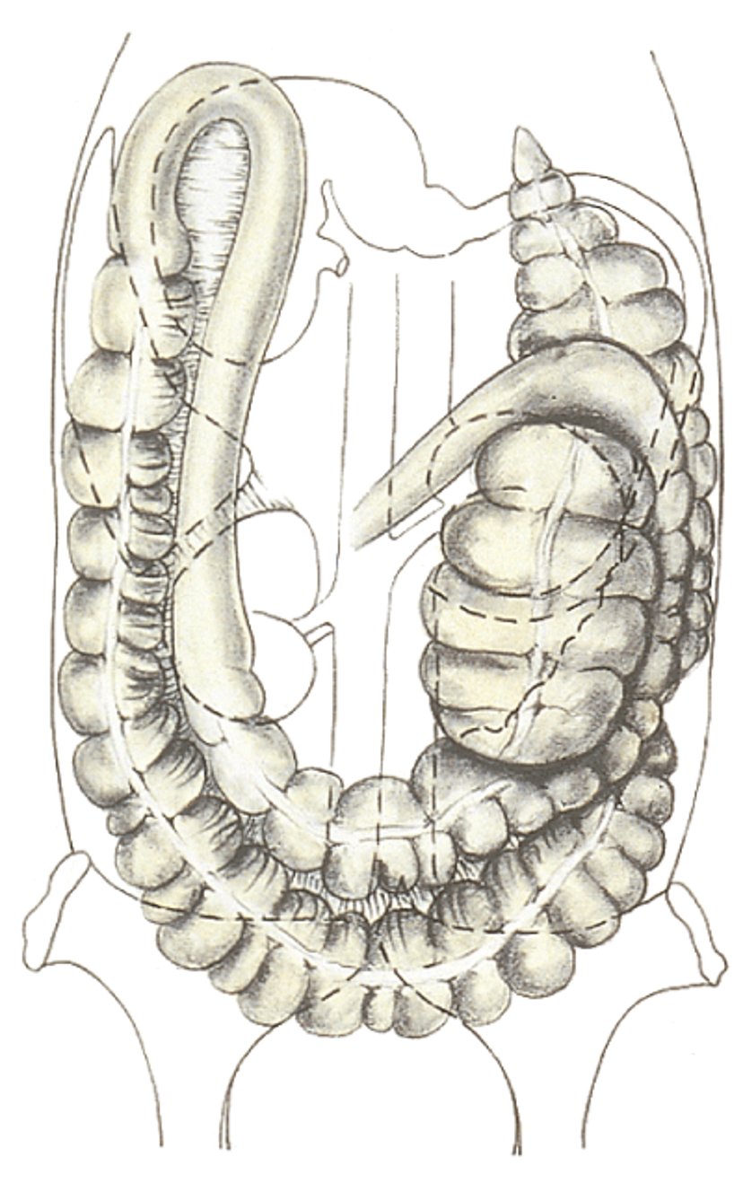 Right dorsal displacement of colon, horse