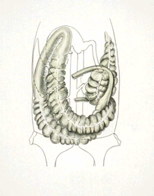 Right dorsal displacement of colon, horse