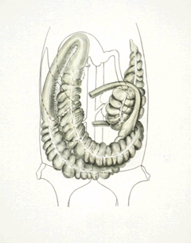 Desplazamiento dorsal derecho del colon, caballo