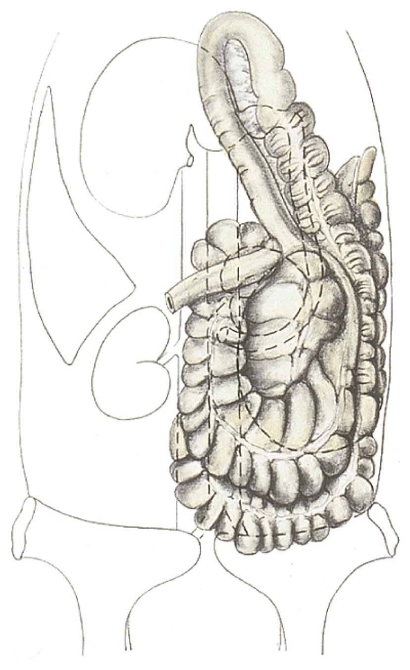 Desplazamiento dorsal derecho del colon, flexión medial, caballo