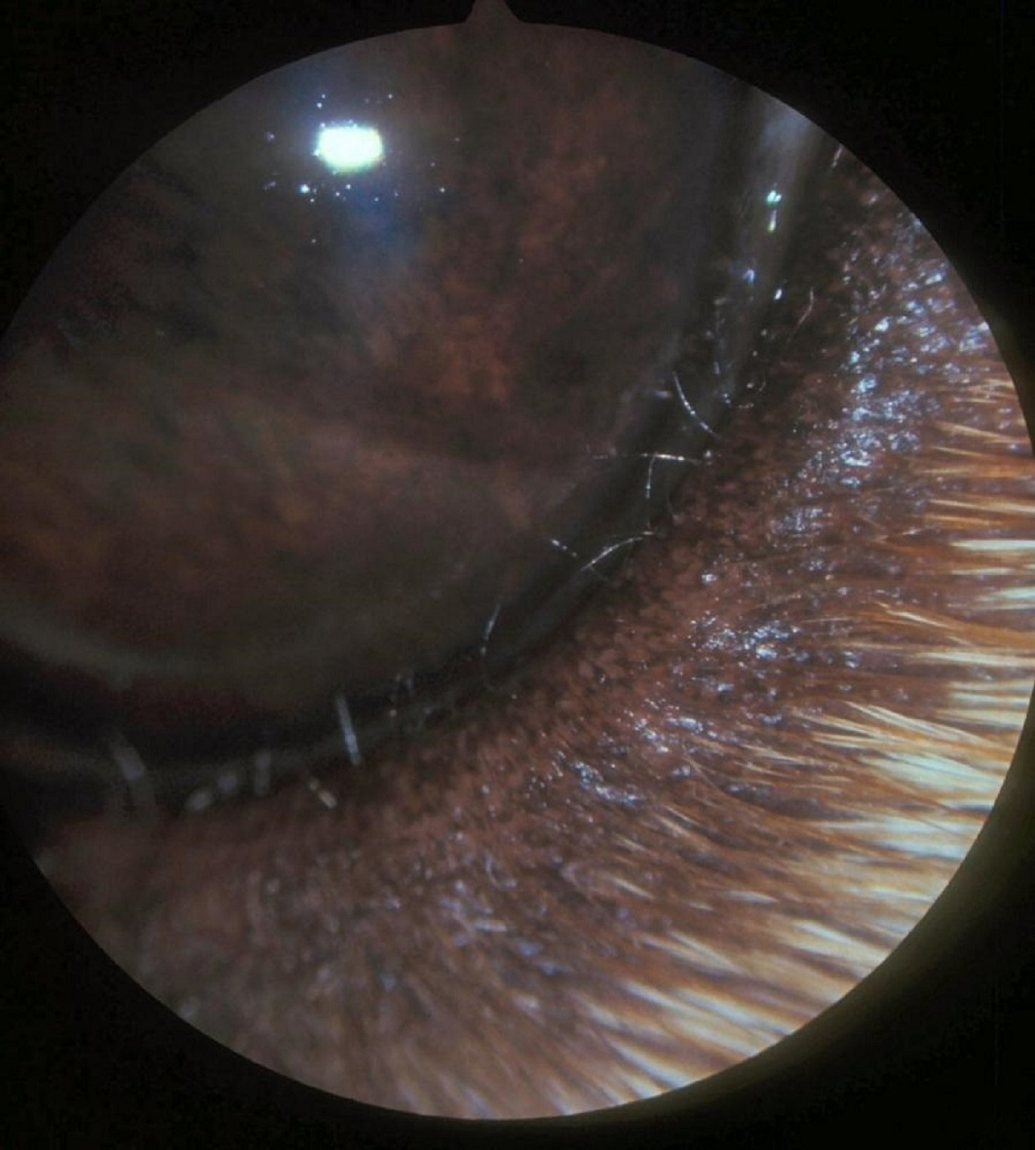 Distichiasis, lower eyelid, dog